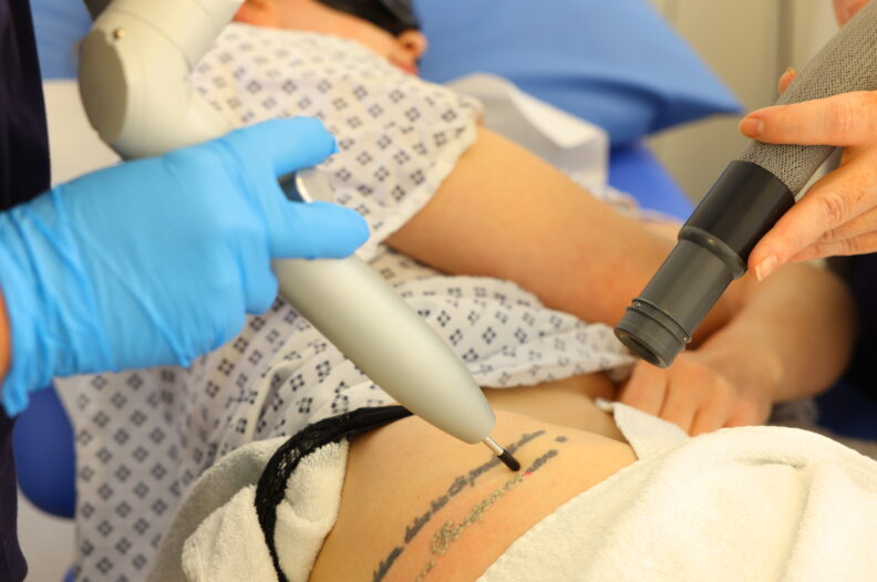 Close up of tattoo removal with lasers